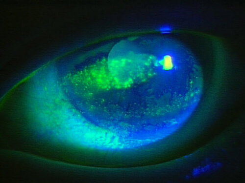 ドライアイの角膜の傷の写真