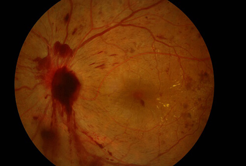 増殖網膜症の眼底写真：新生血管と硝子体出血
