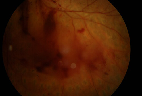 増殖網膜症の眼底写真：新生血管と硝子体出血