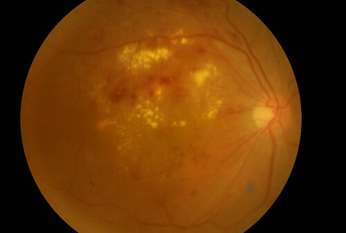 糖尿病黄斑浮腫の眼底写真とOCT画像
